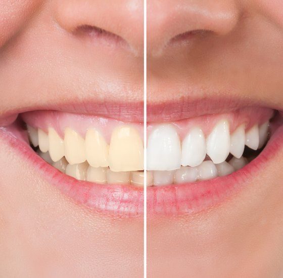 The Best Teeth Whitening Methods That Work